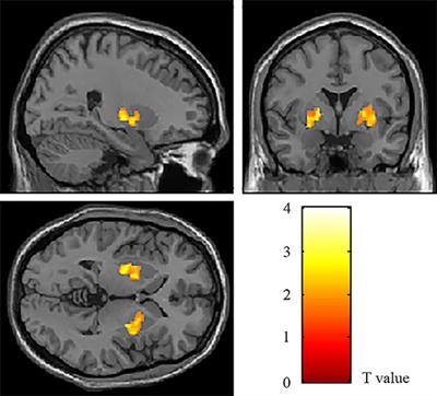 Changes in Volume of Subregions Within Basal Ganglia in Obsessive–Compulsive Disorder: A Study With Atlas-Based and VBM Methods